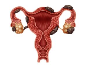 Endometriose – ginecologista alerta sobre riscos de infertilidade causadas pela doença