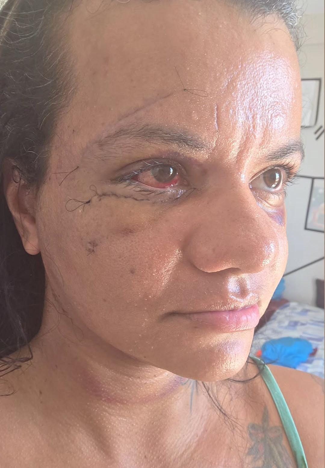 Juliana Soares exibe rosto após cirurgia.