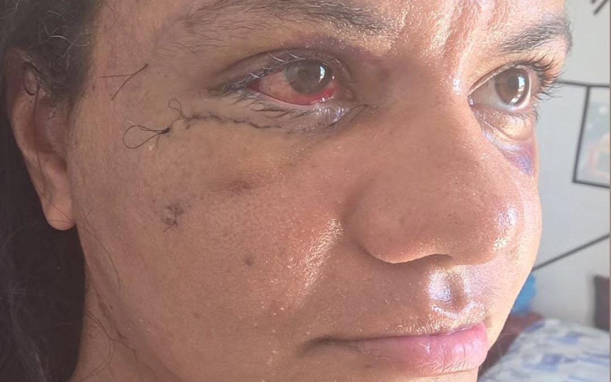 Juliana Soares exibe rosto após cirurgia.